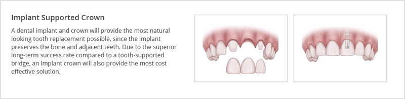 replacing a single missing tooth